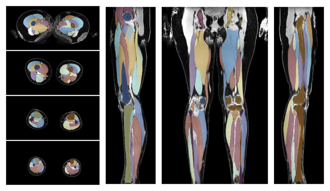 Overlay of automated muscle segmentation labels on dixon water image.